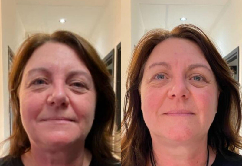 Delphine avant après le kobido chez Naturelia formation kobido villefranche sur saône