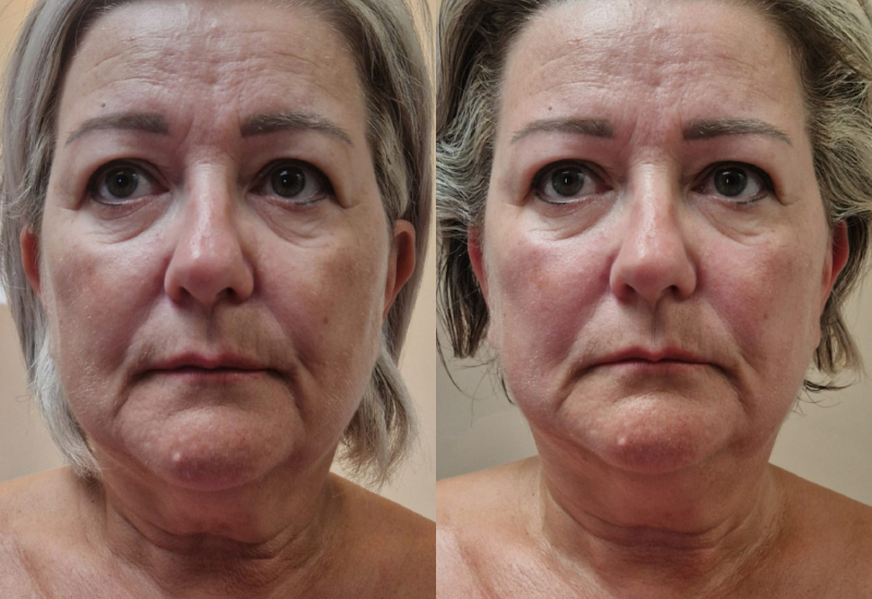 Valérie avant après le kobido chez Naturelia formation kobido villefranche sur saône