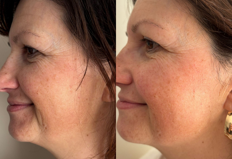 Participante avant après le kobido chez Naturelia formation kobido villefranche sur saône