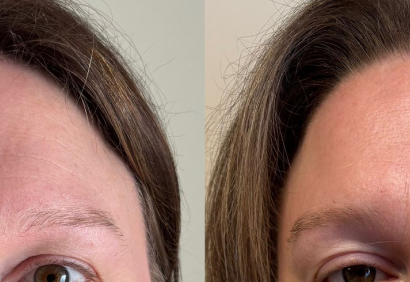 Ride du Lion avant après le kobido chez Naturelia formation kobido villefranche sur saône